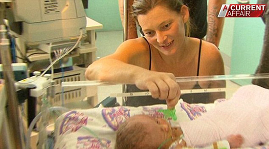 Décès du bébé au « double visage » en Australie