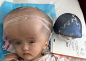 Chine : un bébé malade reçoit un crâne en imprimé en 3D