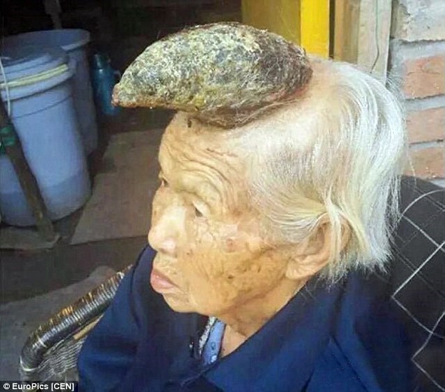 Une corne a poussé sur la tête d'une Chinoise de 87 ans